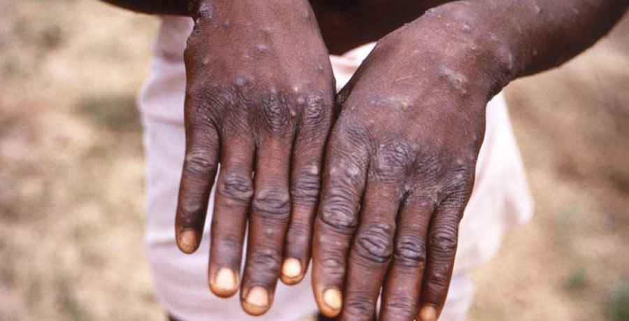 Fear as monkeypox spreads worldwide, rattles WHO, U.S, U.K.