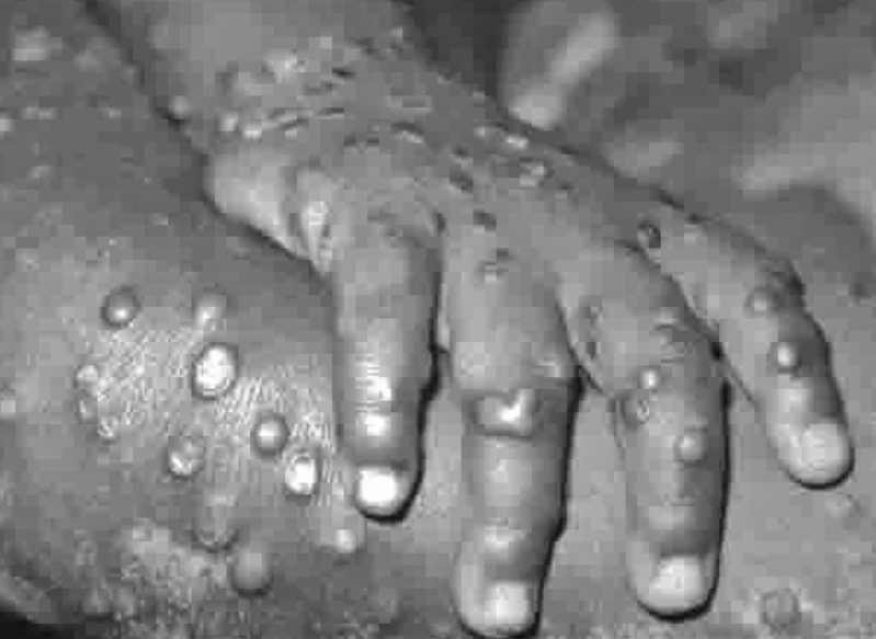 UK to offer monkeypox vaccine to control spread