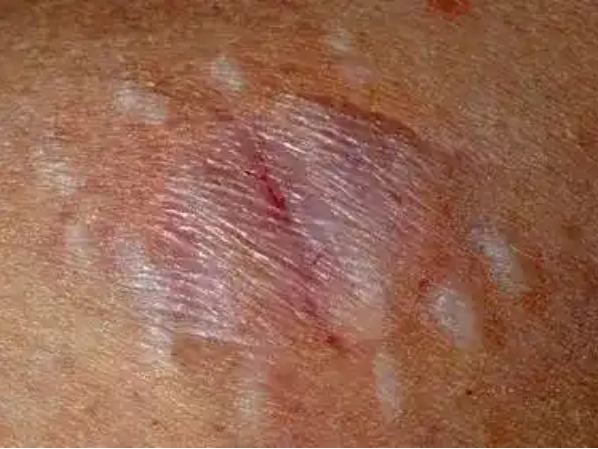 Treatment Of Spider Bite