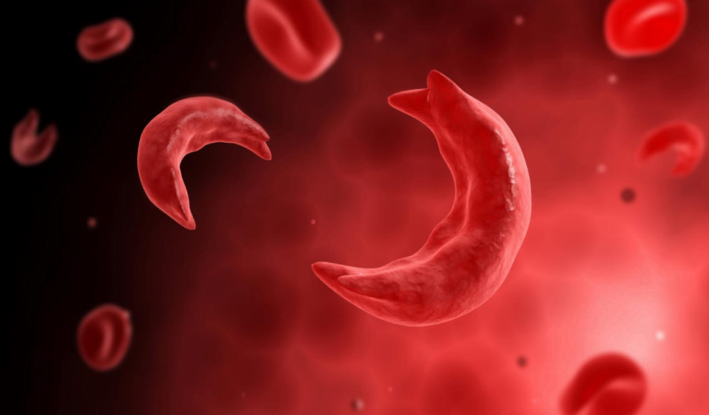 Sickle Cell: How love drove me into devastation – Woman shares experience