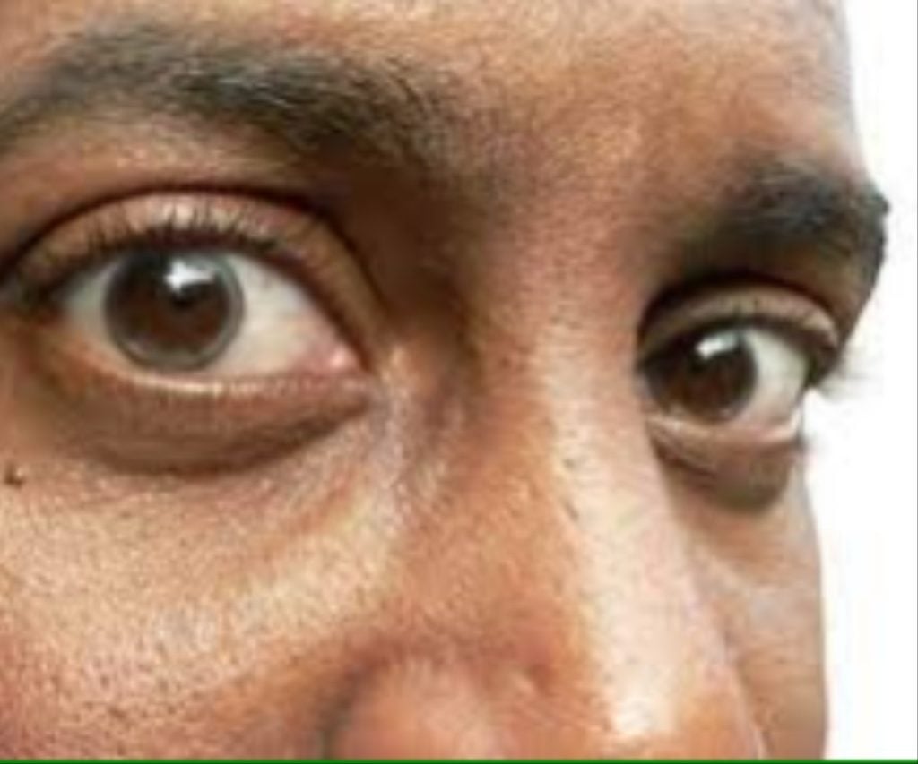 Igbo, Yoruba elderly men at higher risks of glaucoma-induced blindness – Expert warns