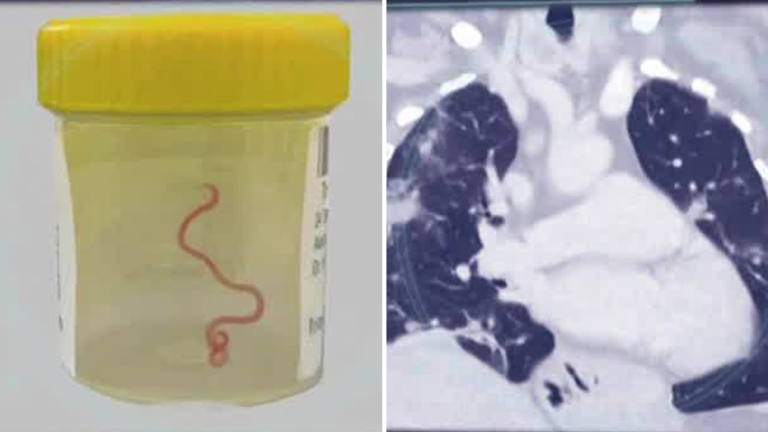 Live worm found in woman’s brain in Australia