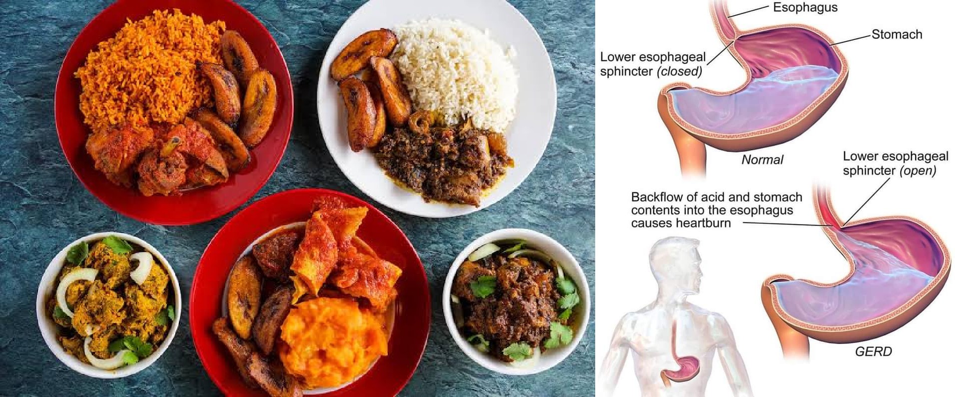 Top 7 Nigerian Foods for Managing Acid Reflux: A Comprehensive Guide