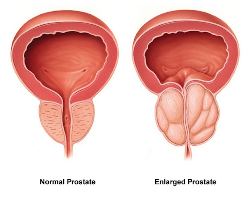 Prostate Gland Enlargement: Causes, Symptoms, and Treatment Options