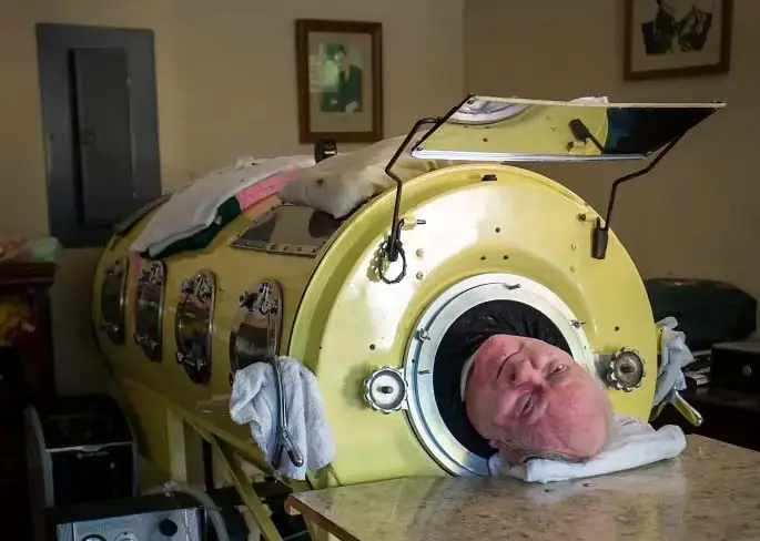 Iron Lung Polio Paul’ Alexander dies at 78