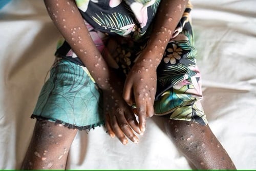 Bayelsa procures PPE to combat monkeypox