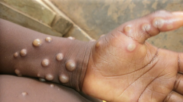 We’ve no Mpox case in Ogun — Govt