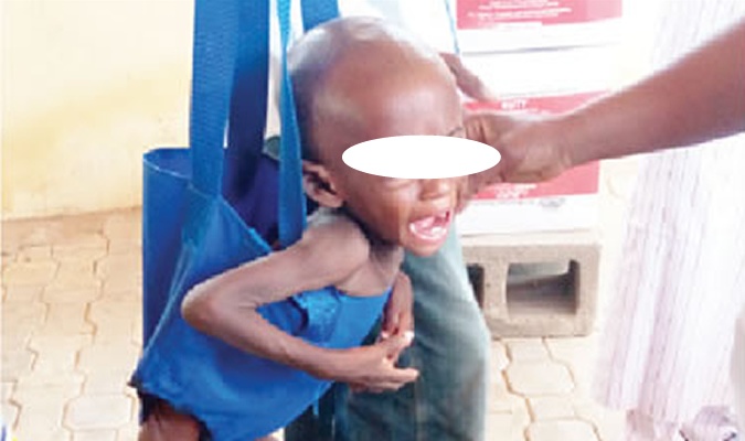 Nigeria’s child malnutrition crisis – Punch – TheCitizen