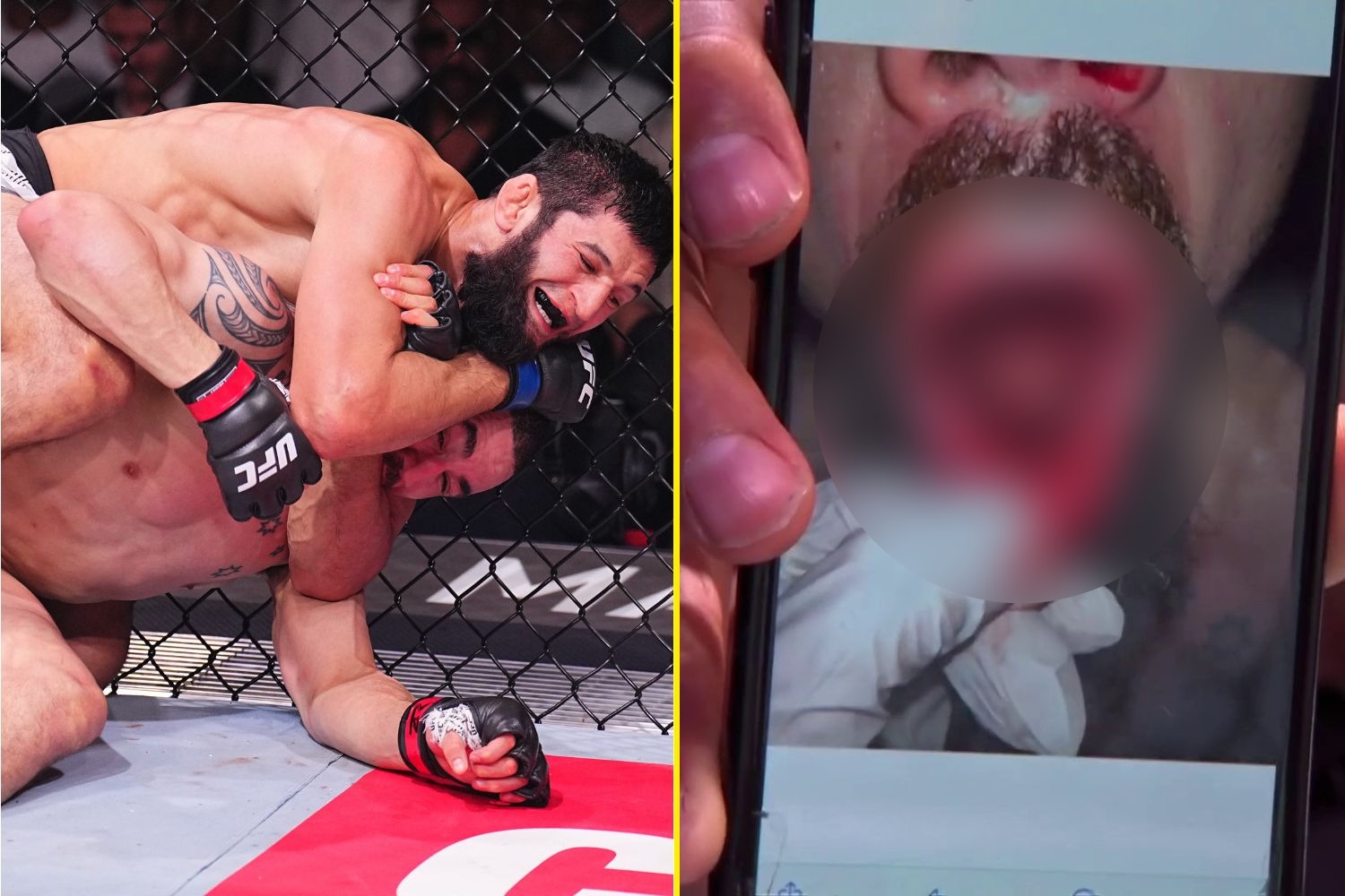 Gruesome photo emerges of Robert Whittaker’s dislocated jaw and dislodged teeth after brutal loss to Khamzat Chimaev