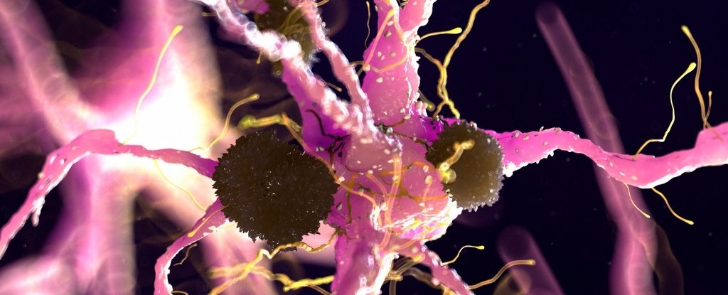 Parkinson’s Discovery Suggests We Already Have an FDA-Approved Treatment : ScienceAlert