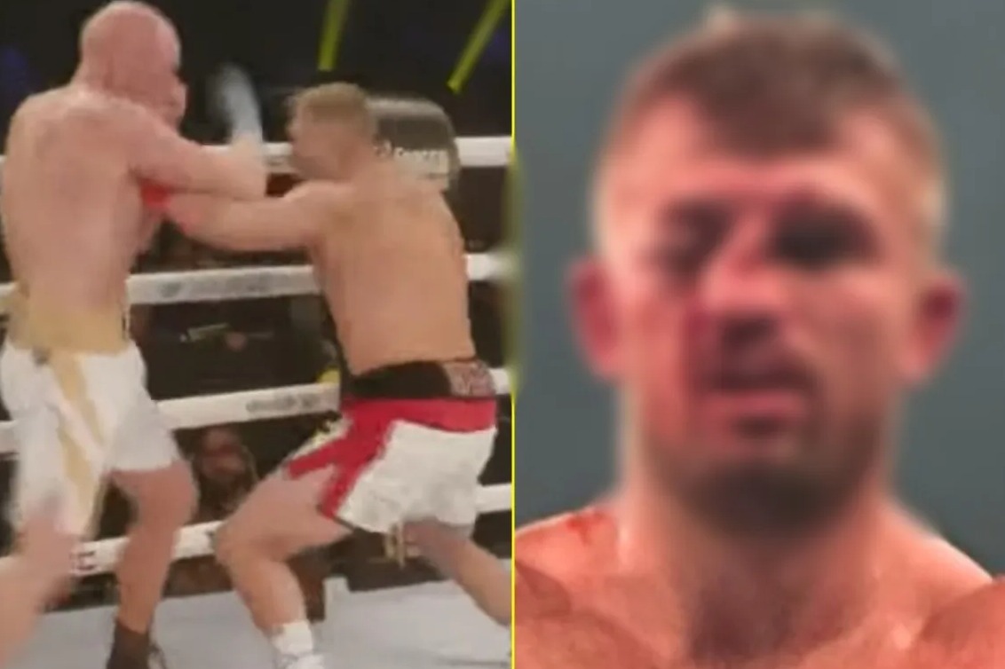 ‘Worst damage ever’ – Bare-knuckle boxer left with face entirely disfigured after brutal war