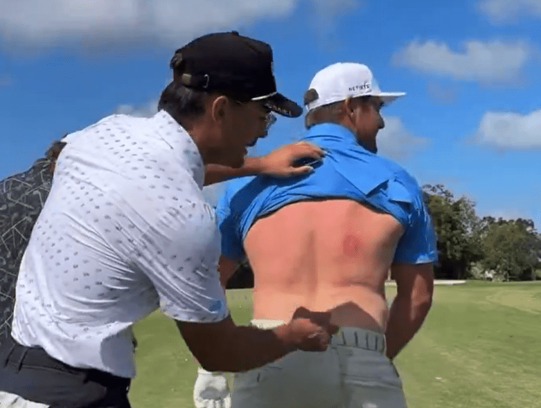 Bryson DeChambeau left with gruesome bruise after being hit with rock hard egg