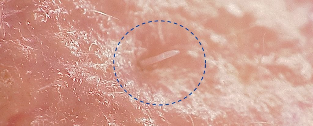 Skin Mites That Mate on Our Faces at Night Are Gradually Merging With Humans