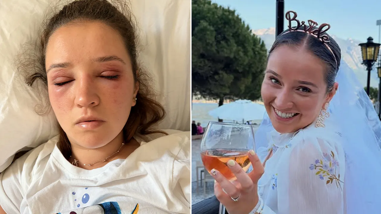 Bride gets severe allergic reaction to eyelash extensions before wedding 4 Bride gets severe allergic reaction to eyelash extensions before wedding